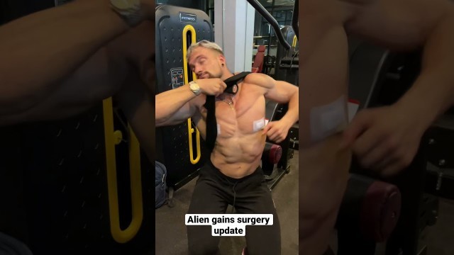 'Alien gains Surgery Update'