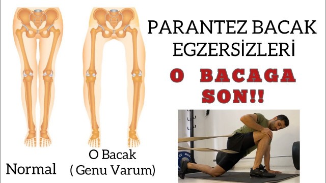 'Fizyoterapistten Parantez Bacak Egzersizleri | O Bacak | Genu Varum | Fizyoterapist Ömer Güngür'